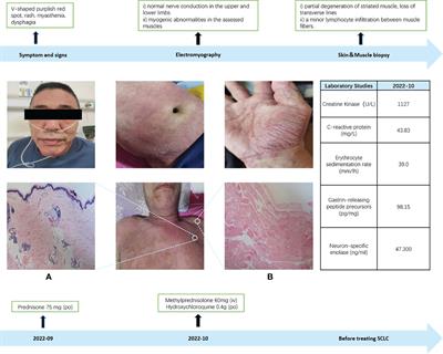 Small cell lung cancer with dermatomyositis: a case report
